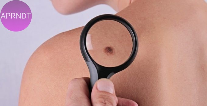 enfermedades relacionadas a los lunares