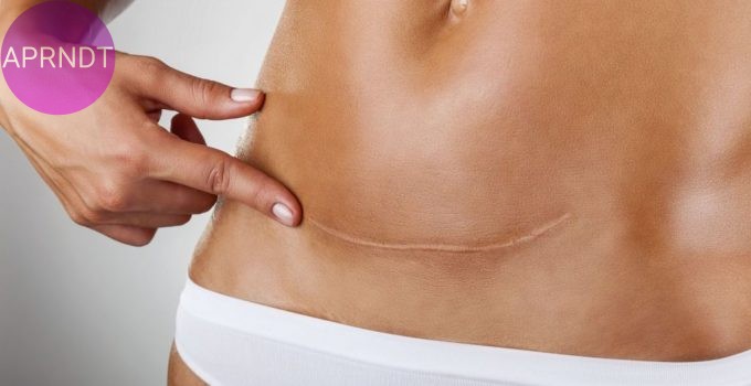 remedios caseros para la cicatrización post-parto