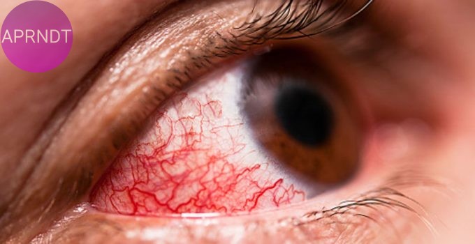 4 remedios naturales para la conjuntivitis